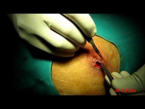 Abdominal Wall Abscess Drainage In An Elderly Diabetic Lady
