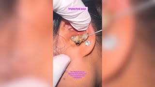 Satisfying Pimple Popping & Cyst Extractions -68