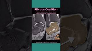 Coalition 11 Fibrous Coalition On Mri How To Recognize The Subtlest Type