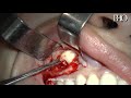 Extracción de dientes supernumerarios en maxilar superior