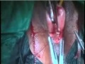 prolapse uterus,cervix amputation,conservative mesh repair ,dr cv hegde,mumbai,india.wmv