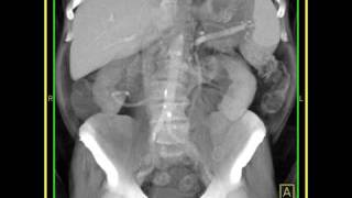 Abdomen Small Bowel Carcinoid Tumor Of The Small Bowel 3D Volume Rendering