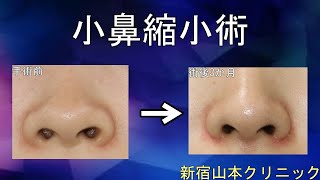 小鼻縮小(鼻の穴を小さく) 山本クリニック