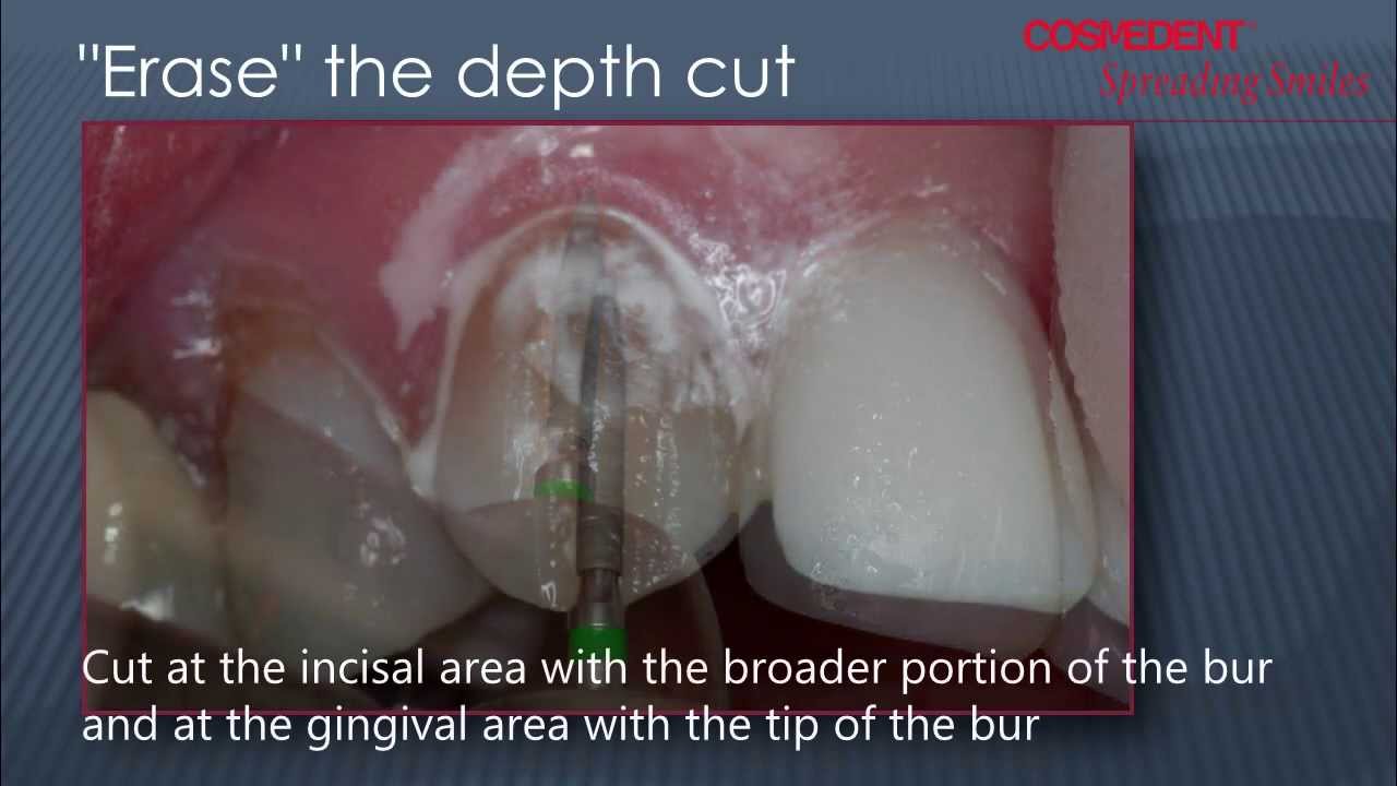 Composite Veneers Preparation YouTube