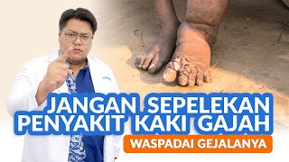 Kaki Gajah Masih Ada Di Indonesia, Waspadai Penyebabnya