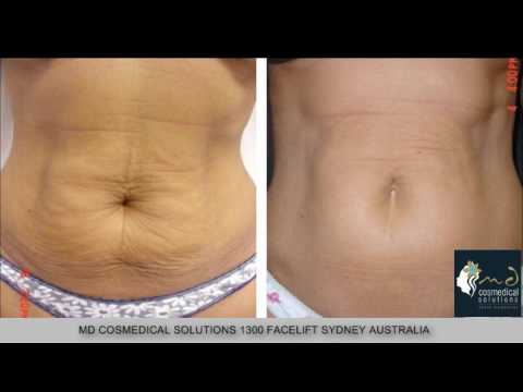 0 Stretch marks treatment with fraxel restore laser Sydney