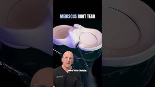 Why Meniscus Root Tears Are Worse Than You Think