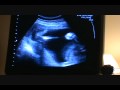 3d ultrasound of baby J