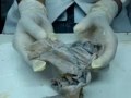 Meninges Pathology | RM. Meninges Pathology | RM.