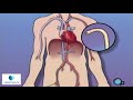 Stent Implantation Coronary Angioplasty Vidant PreOp® Patient Education