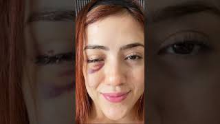 Combate Globals Yazmin Najeras Orbital Fracture Womens Mma Fighter