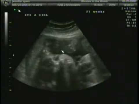 3d ultrasound pictures at 26 weeks. 27 week 3D ultrasound