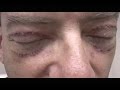 The Causes of Temporary Swelling after Asian Double Eyelid Surgery & Different Approaches to Healing default The Causes of Temporary Swelling after Asian Double Eyelid Surgery & Different Approaches to Healing