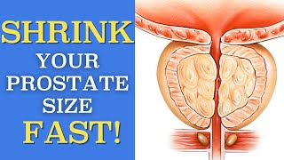 How to Avoid a Catheter with an Enlarged Prostate Gland | 3 Ways to Reduce an En