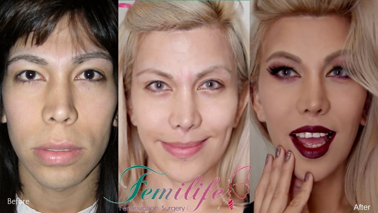 Facial feminization dr