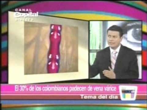 La enfermedad varicosa de las venas de las extremidades inferiores de la foto