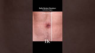 Outie To Innie Umbilicoplasty Belly On Revision Surgery Dr. Khorasani