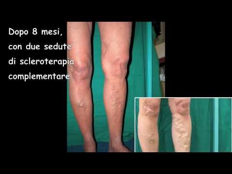 Trattamento di varicosity senza operazione