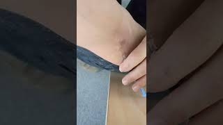 59 Auto-Venipuncture, Right Arm, Vena Cefalica, Vena Basilica, Syringre, Narrow Gauge Needle.