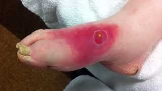 Comments Off on Diabetes Cellulitis Complications