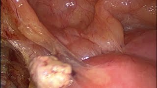 Complex Hysterectomy