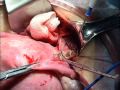Hysterectomy for Benign Disease #6