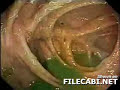 Lombrices Intestinales