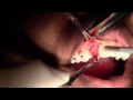 Implant Placement #7 Site, NB Replace, Full Video