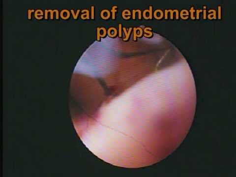 Stages of cervical cancer and remedy small cellular cervical cancer