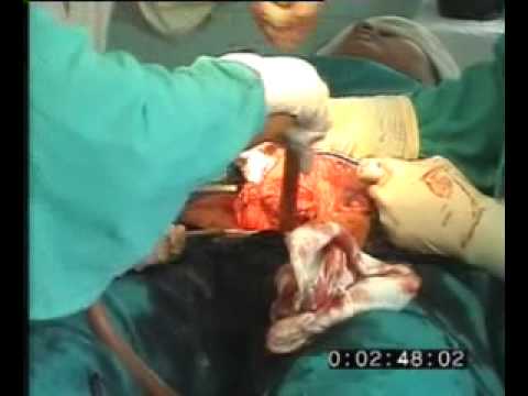 FASTEST C SECTION SURGERY IN AREA HOSPITAL FASTEST C SECTION SURGERY IN AREA HOSPITAL