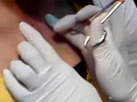 Watch and get video html code for SUELLA - clavicle surface piercing