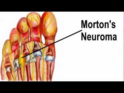 Nerve Pain: Shooting Nerve Pain All Over Body