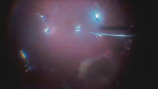 Subretinal Pfcl Aspiration With 41G Needle Lukan Mishev Live Stream