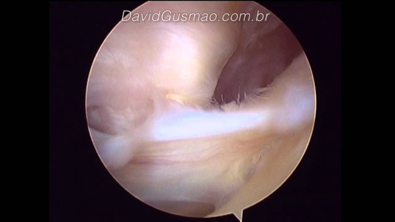 Hip Arthroscopy: Psoas tendon abnormally inside the hip joint - YouTube