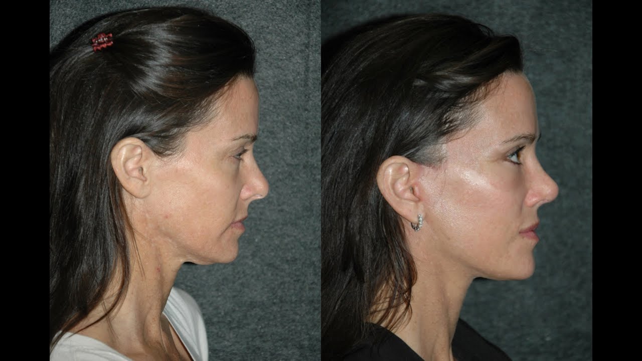 Insurance settlements for facial scar