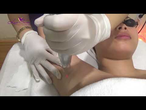 ĐIỀU TRỊ THÂM NÁCH CÔNG NGHỆ LASER YAG