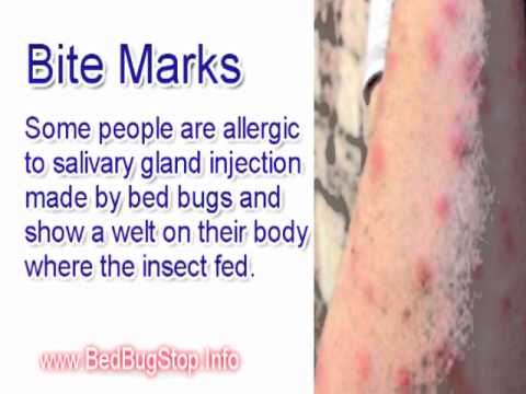 Bed Bug Bite Pictures | Bed Bug Bite Mark Pictures - YouTube