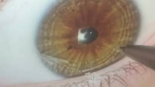 Right Eye Reading - Iridology