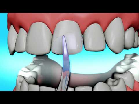 diy dental bonding teeth bonding teeth bonding procedure how to save diy dental bonding teeth bonding teeth bonding procedure how to save