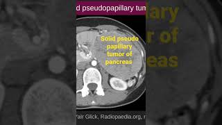 Solid Pseudo Papillary Tumor Of The Pancreas