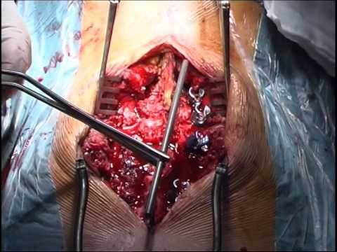 Si puede levantarse la temperatura a la osteocondrosis lumbar