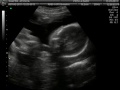 2D/3D Twin Ultrasound at 24 weeks!