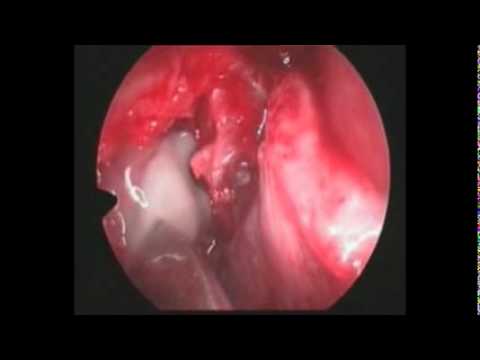 dcr endoscopic
