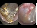 141 - Very Impacted & Stubborn Dead Skin Plugs Extracted from Ear using WAXscope®️