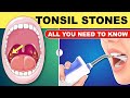 Tonsil Stones | Tonsil Stones Treatment | Tonsil Stone Removal - All You Need to Know