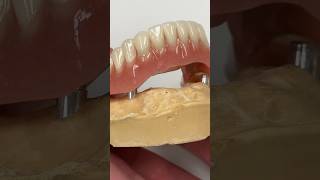 Lower Locator Denture