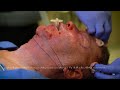 Renuvion (J-Plasma) Neck Tightening + Full Face Resurfacing - Dr. Ruff | West End Plastic Surgery