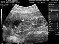 BEBE DE GISELLE Y MANUEL 15 SEMANAS