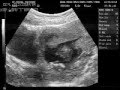 BEBE DE GISELLE Y MANUEL 15 SEMANAS
