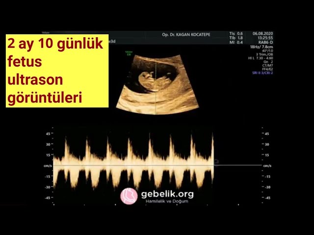 10 haftalık (2 aylık) gebelikte bebek ultrasonda nasıl gözükür? Cinsiyet erkek mi, kız mı? Cevap:??